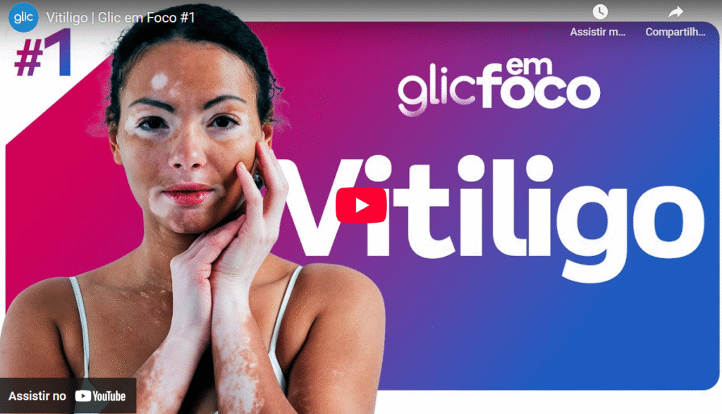 Glic em Foco #1 - Vitiligo